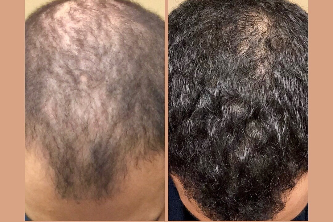 Hims -Hair Growth Treatment