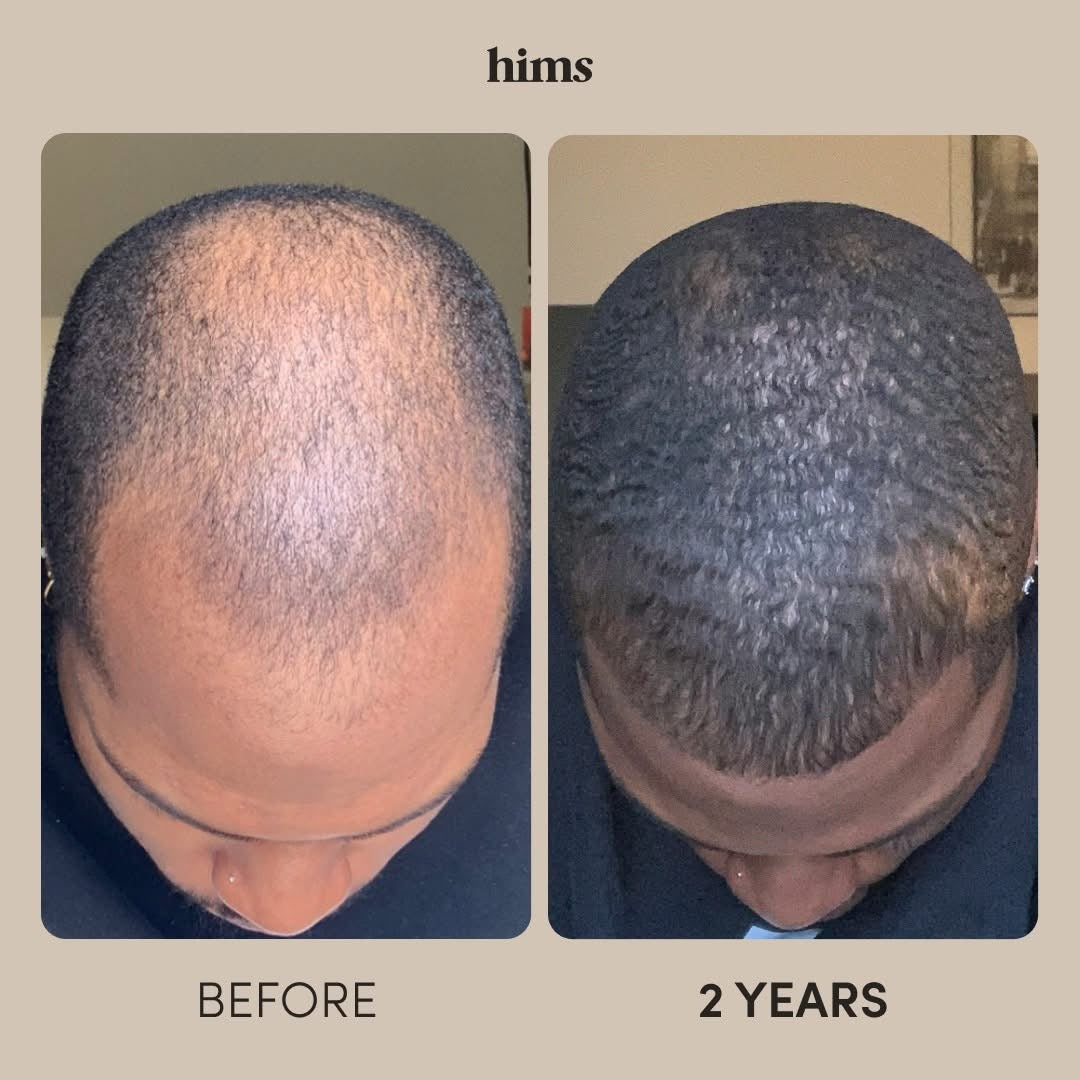 Hims -Hair Growth Treatment